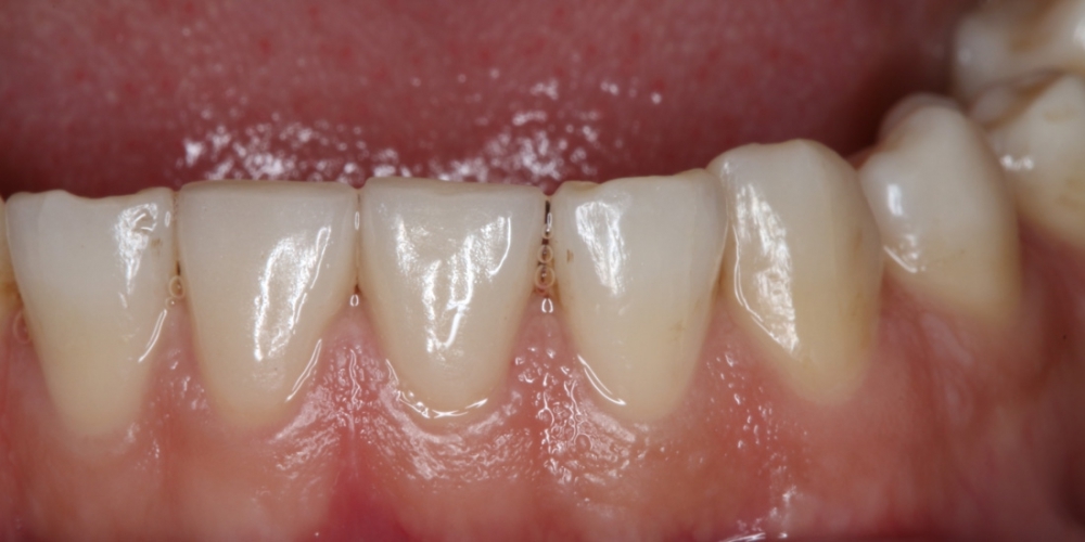 Реставрация керамическими винирами E-max (двух верхних и нижних зубов) - фото №2