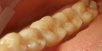 Лечение кариеса 4 зубов в одно посещение - фото №1