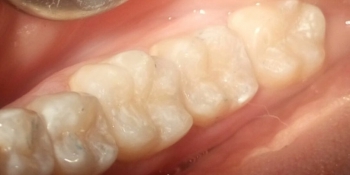 Лечение кариеса 4 зубов в одно посещение - фото №2