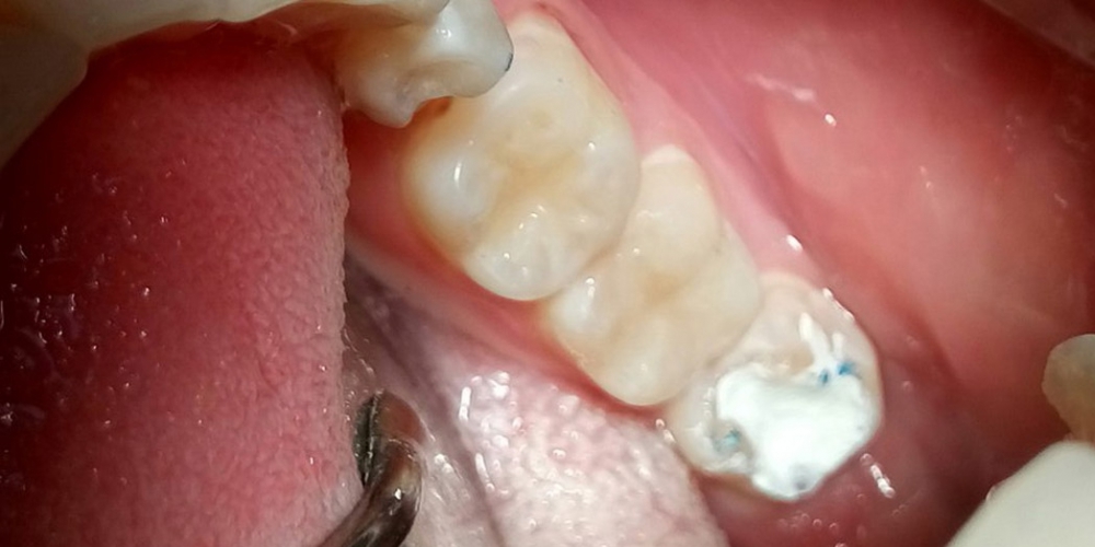 Лечение глубокого кариеса двух зубов - фото №1