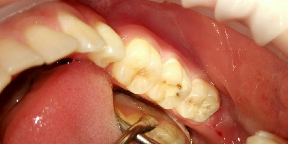 Лечение глубокого кариеса двух зубов - фото №2