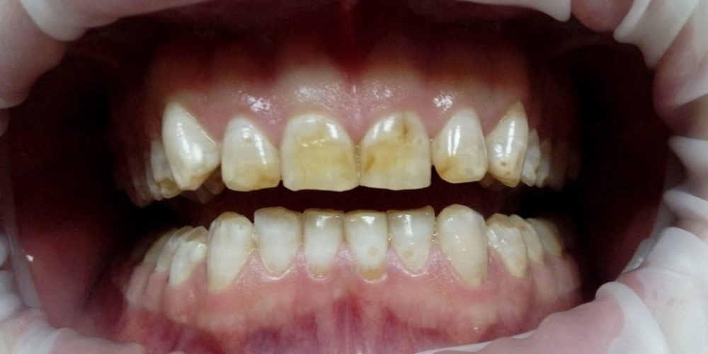 Эстетическая реставрация зубов композитными винирами - фото №1