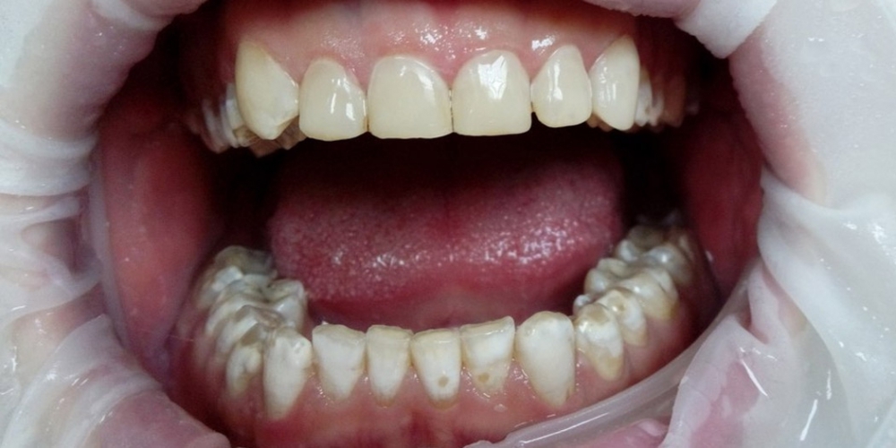Эстетическая реставрация зубов композитными винирами - фото №2