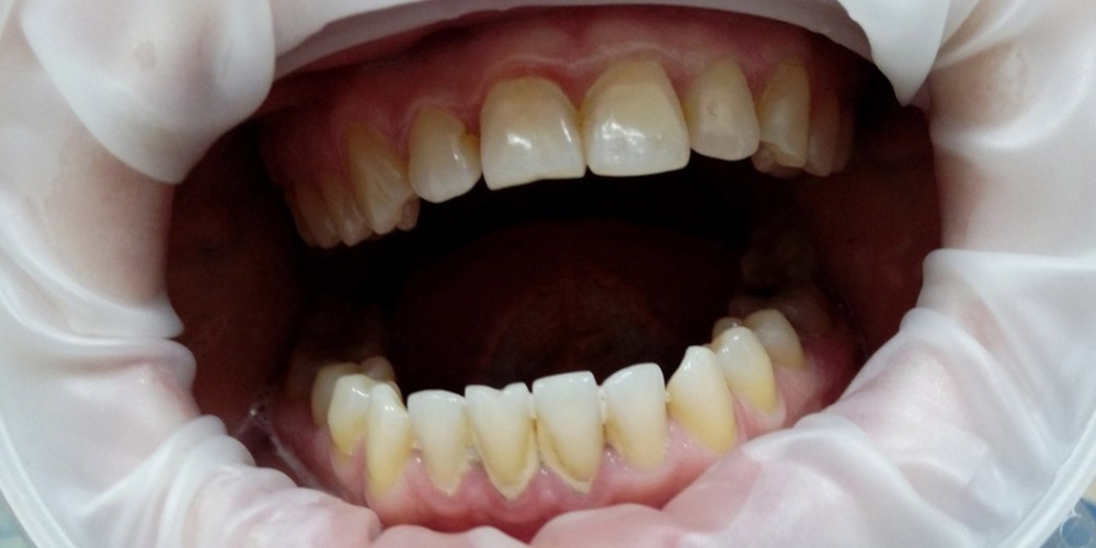 Результат снятия зубного камня ультразвуком - фото №1