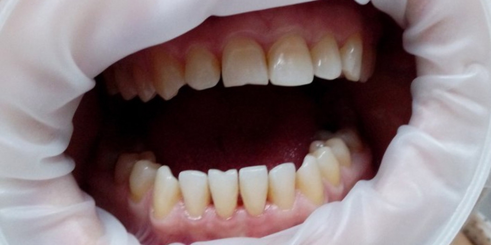 Результат снятия зубного камня ультразвуком - фото №2