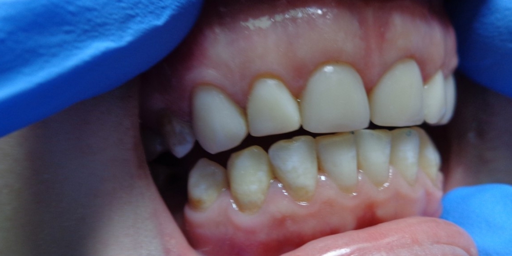 Реставрация зубов композитными винирами - фото №6