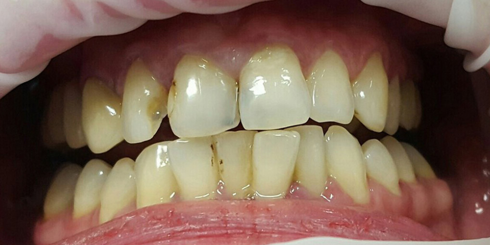 Лечение кариеса и реставрация двух передних зубов - фото №1