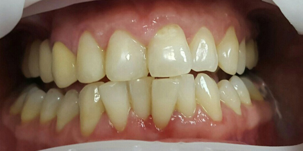 Лечение кариеса и реставрация двух передних зубов - фото №2