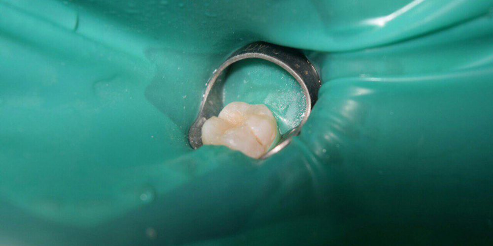 Лечение глубокого кариеса жевательного зуба - фото №2