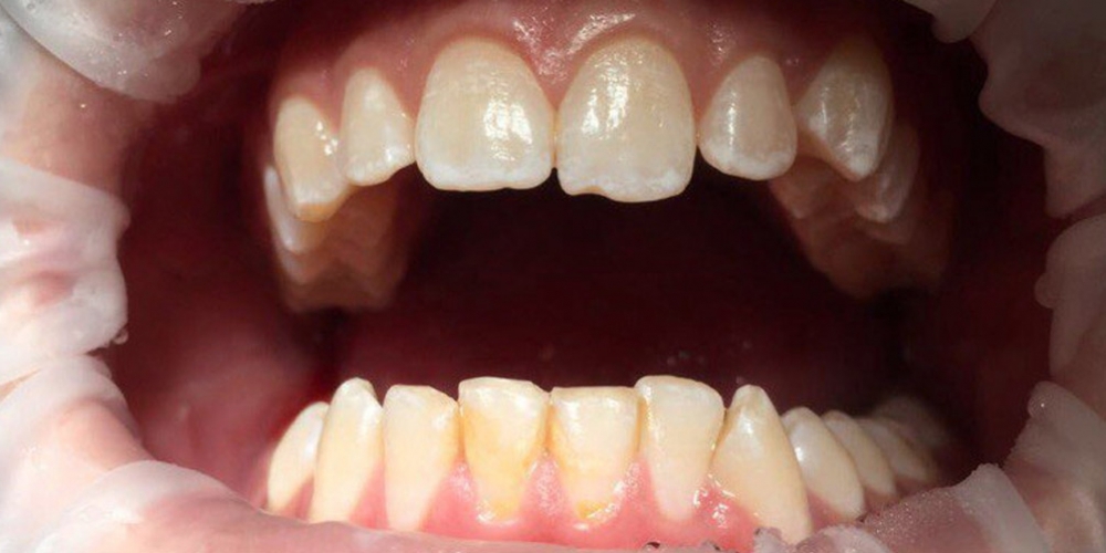 Профессиональная гигиена всей полости рта с последующей полировкой и реминерализацией - фото №1