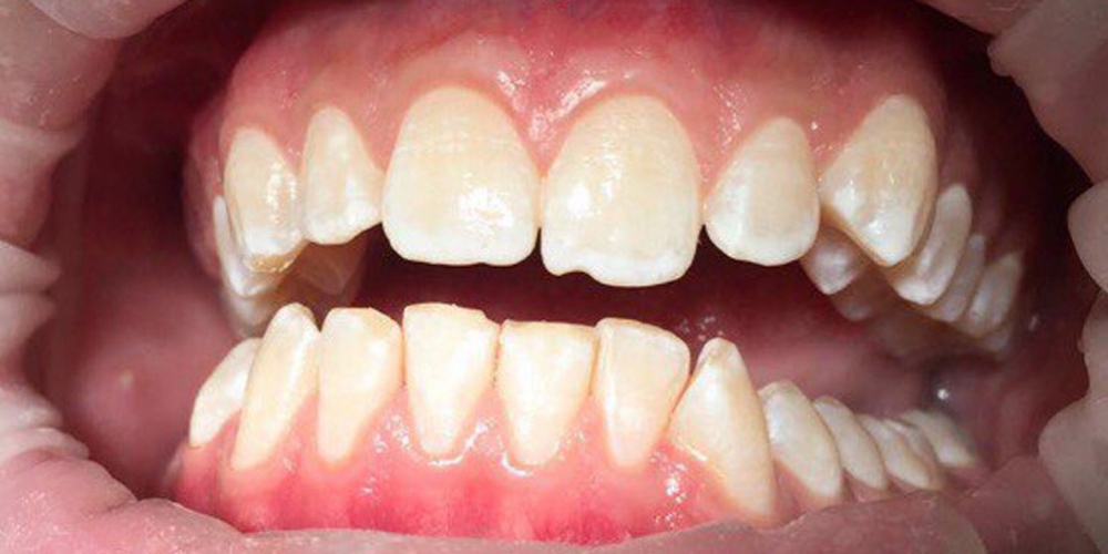 Профессиональная гигиена всей полости рта с последующей полировкой и реминерализацией - фото №2