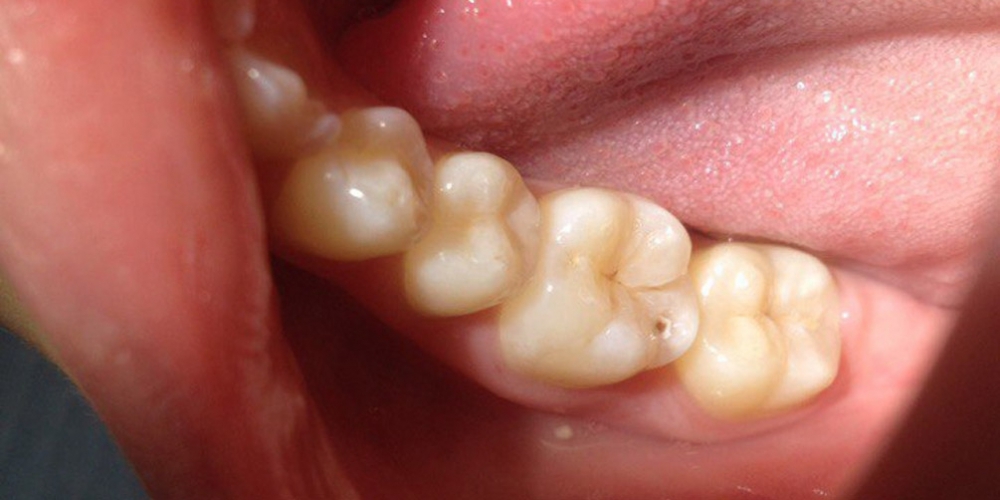 Результат лечения поверхностного кариеса жевательного зуба - фото №1