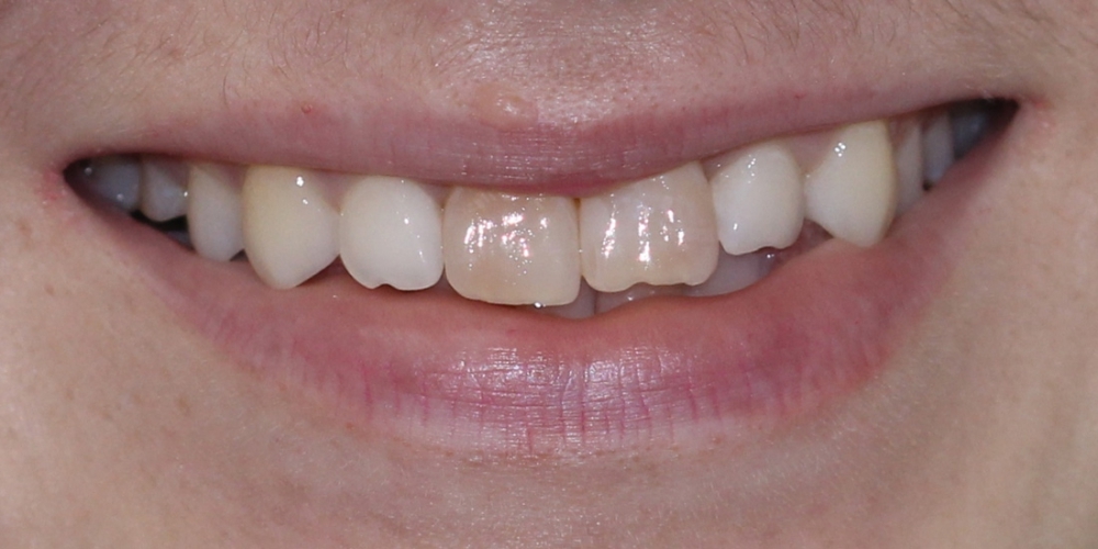 Установка двух керамических виниров на передние зубы - фото №1