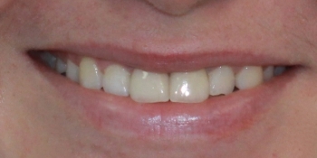 Установка двух керамических виниров на передние зубы - фото №4