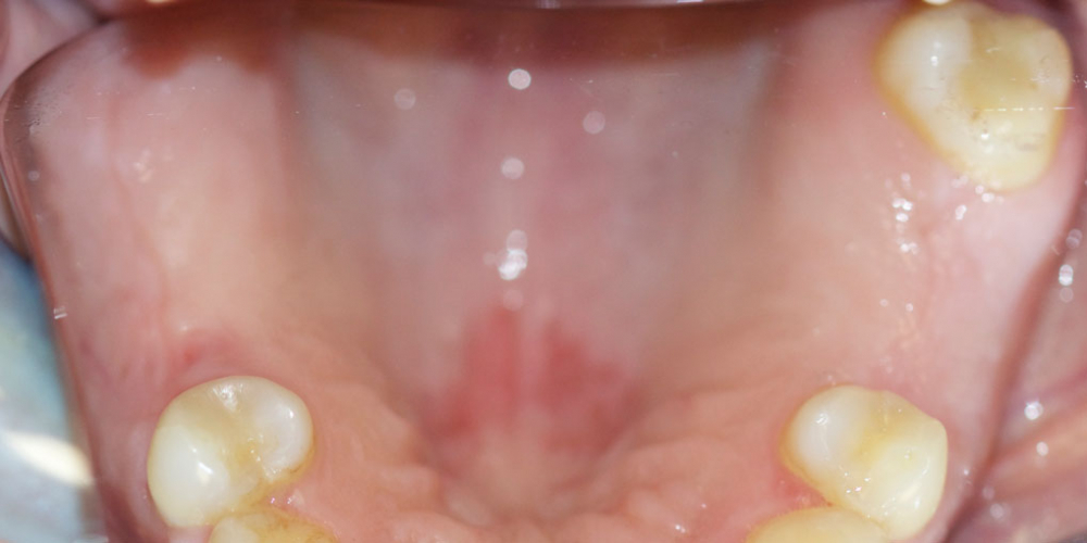 Восстановление жевательной функции зубов на нижней челюсти бюгельными протезами - фото №1