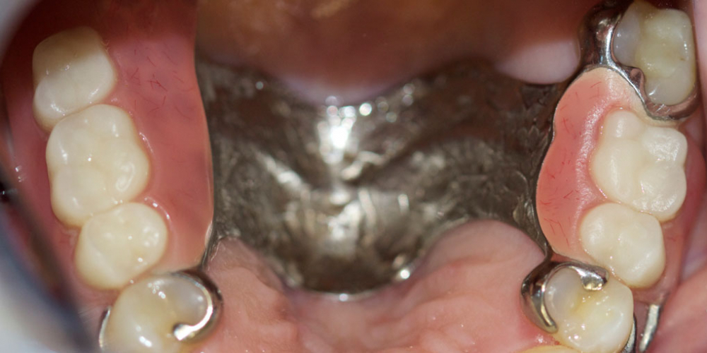 Восстановление жевательной функции зубов на нижней челюсти бюгельными протезами - фото №2