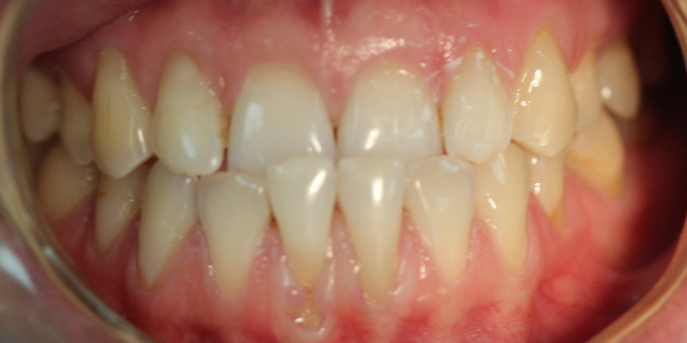 Исправление прикуса зубов на аппаратах съемного типа - фото №1