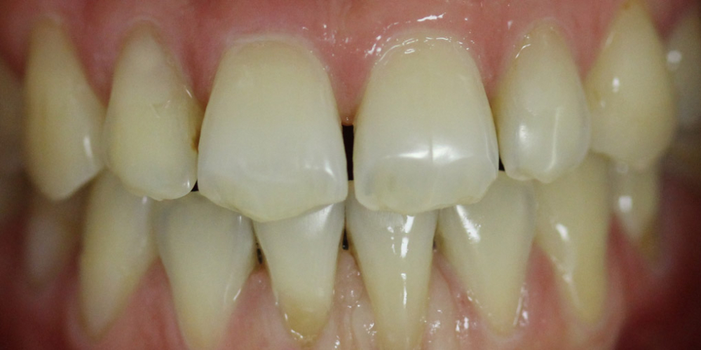 Исправление прикуса зубов на аппаратах съемного типа - фото №2