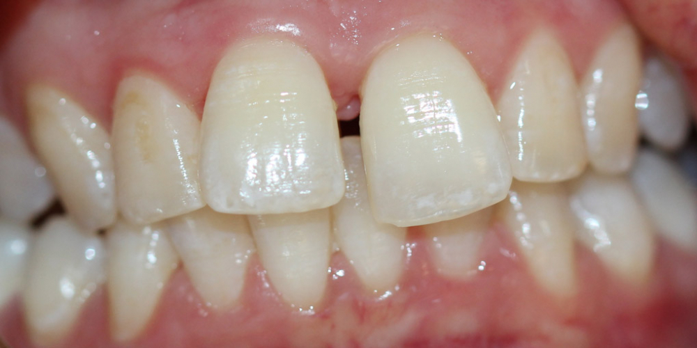 Устранение щели между зубами съемными аппаратами - фото №1
