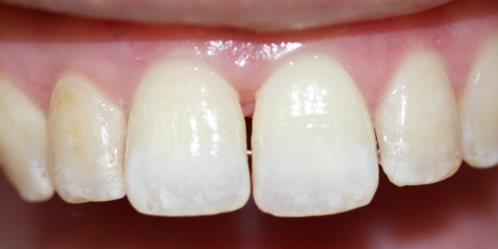 Устранение щели между зубами съемными аппаратами - фото №2