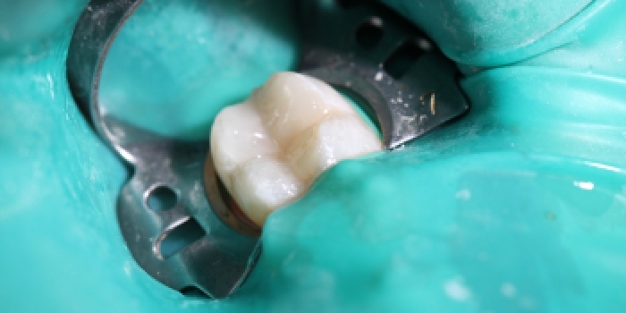 Лечение кариеса жевательного зуба - фото №2