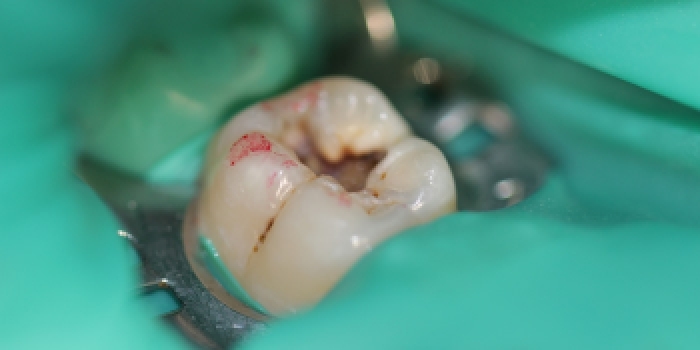 Лечение кариеса зуба - фото №1