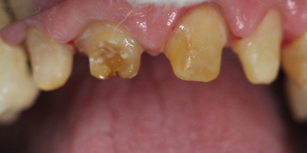 Безметалловая керамика E-max на передние зубы - фото №1