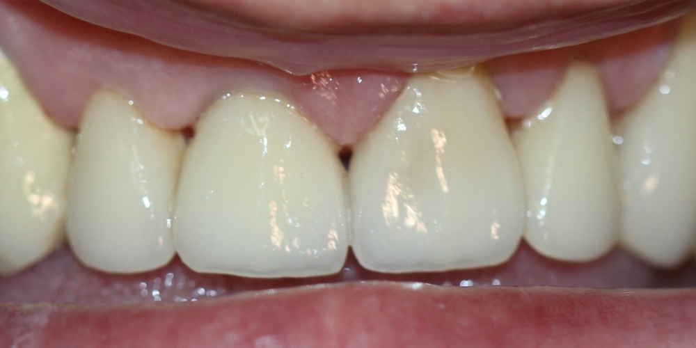 Безметалловая керамика E-max на передние зубы - фото №2