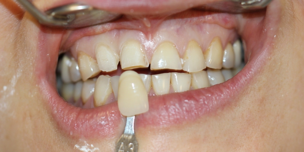 Керамические (безметалловые) виниры Е-МАХ на 6 передних зубов - фото №1