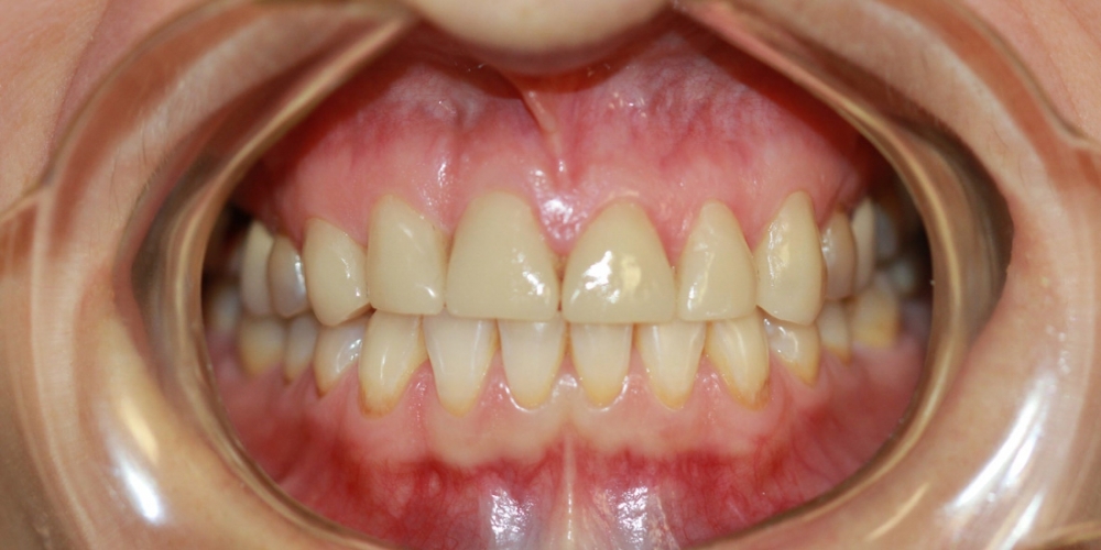 Керамические (безметалловые) виниры Е-МАХ на 6 передних зубов - фото №2