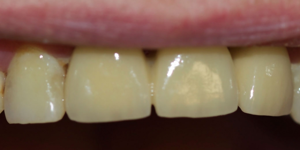 Мостовидный металлокерамический протез на передние зубы - фото №2
