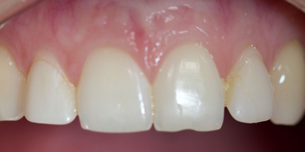 Виниры на передние зубы и реставрация резца - фото №1
