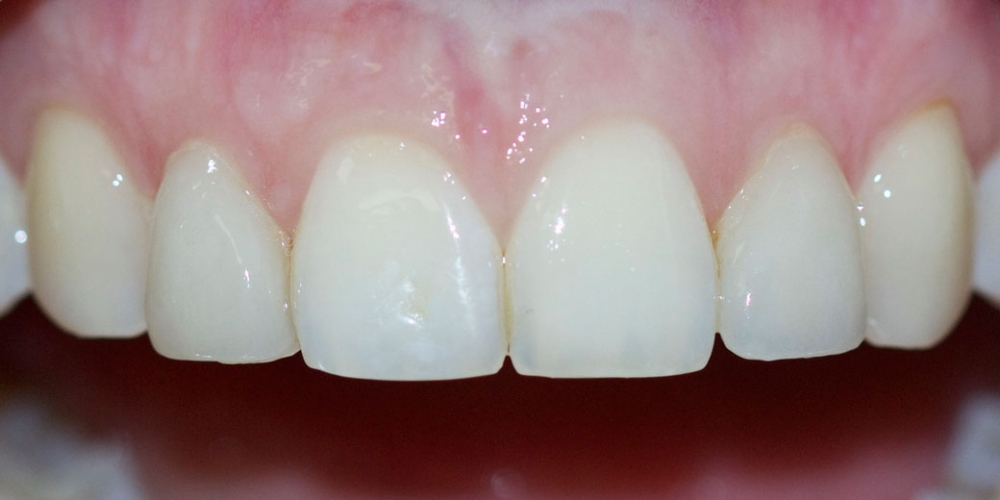 Виниры на передние зубы и реставрация резца - фото №2