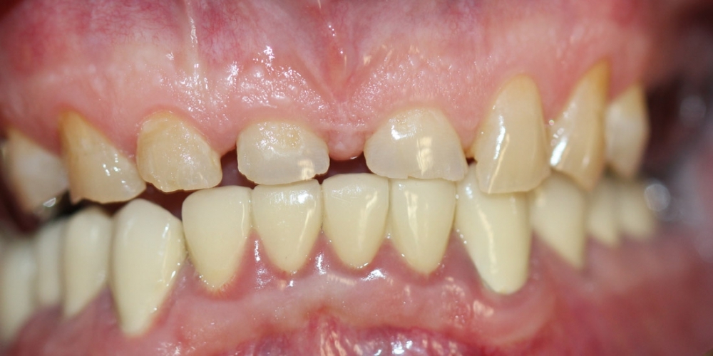 Восстановление всех зубов композитным материалом, изготовление и установка металлокерамических корон - фото №1