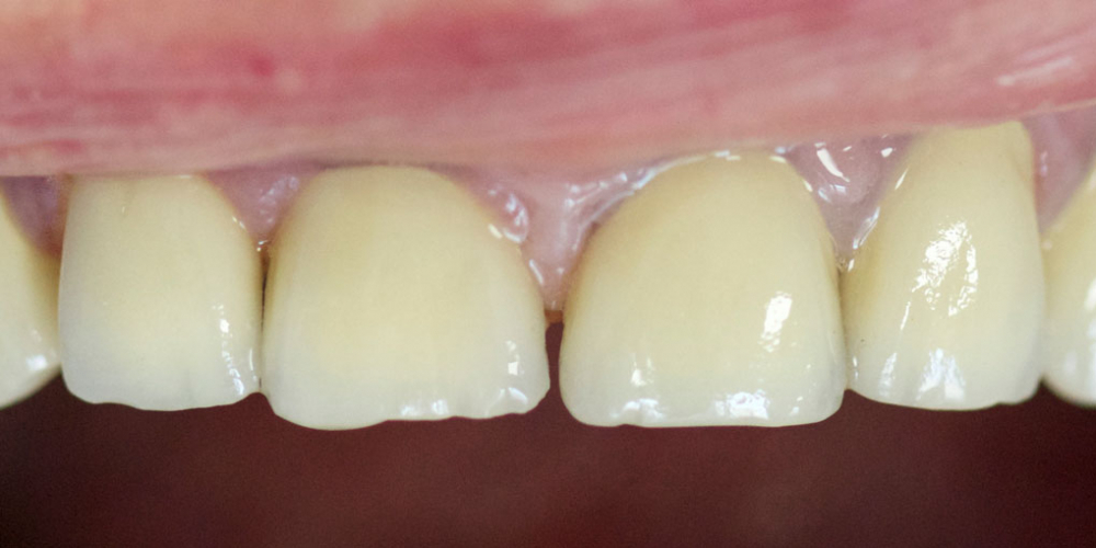Восстановление всех зубов композитным материалом, изготовление и установка металлокерамических корон - фото №2