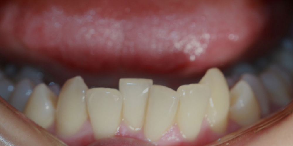 Выравнивание зубов на нижней челюсти - фото №1