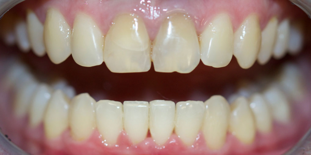 Выравнивание зубов на нижней челюсти - фото №2