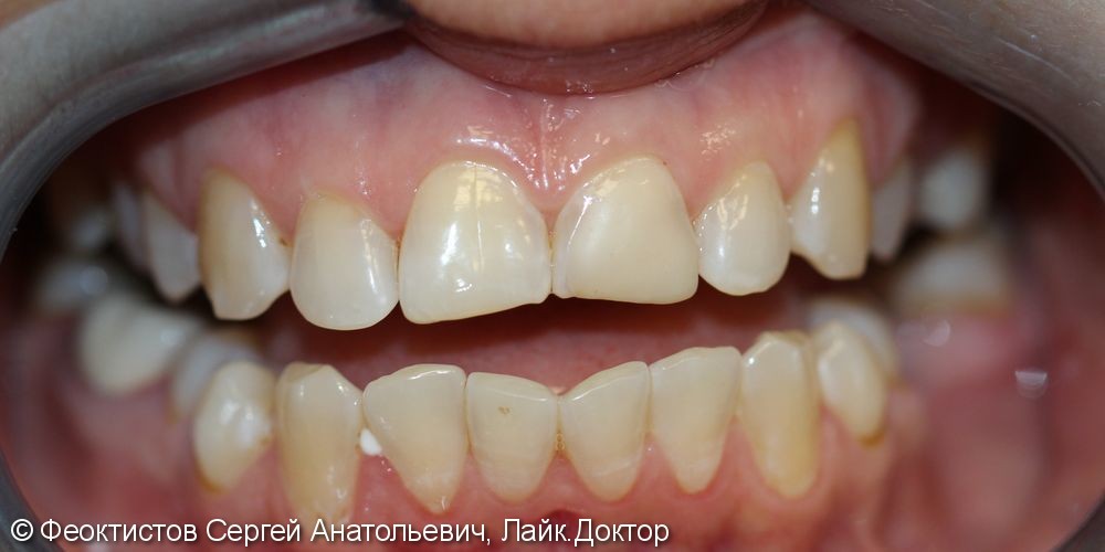 Керамические виниры на 8 передних зубов, до и после - фото №1