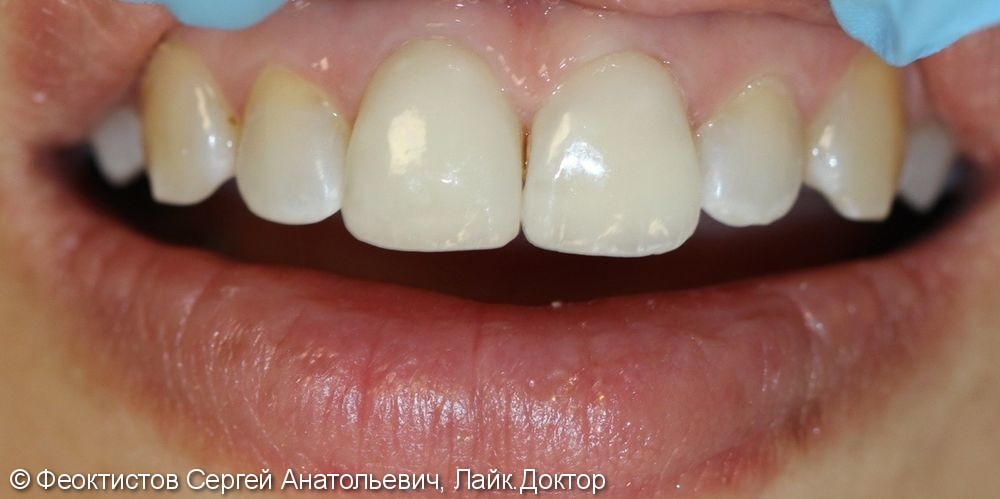 Керамические виниры на 8 передних зубов, до и после - фото №4