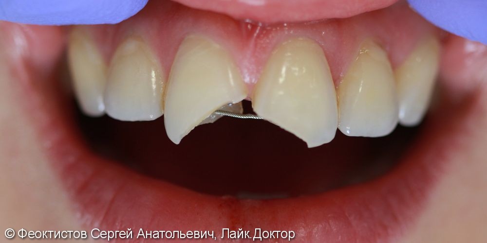 Эстетическая реставрация сколов передних зубов, результат до и после - фото №1