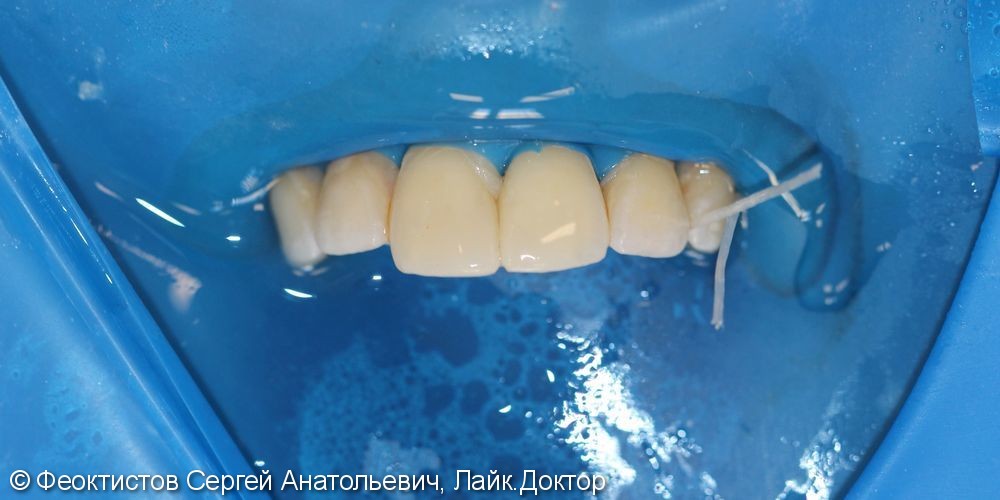 Эстетическая реставрация сколов передних зубов, результат до и после - фото №2