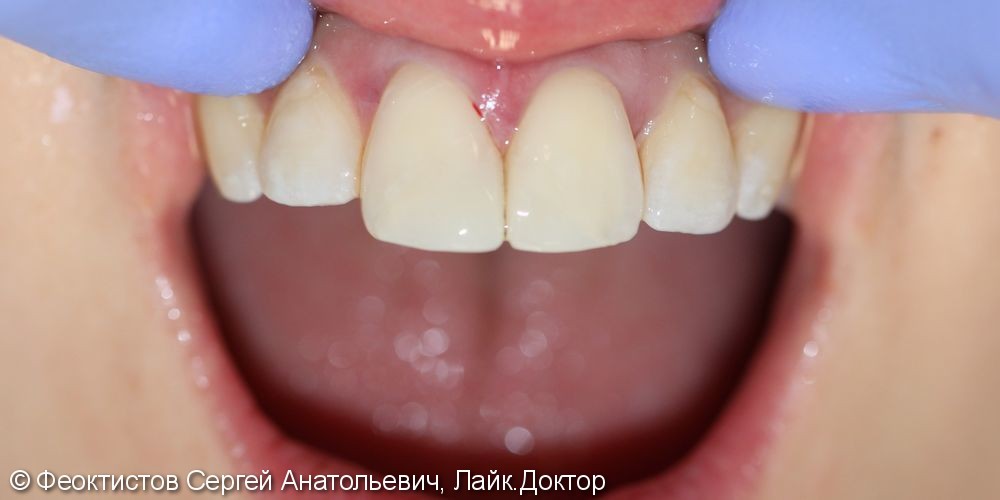 Эстетическая реставрация сколов передних зубов, результат до и после - фото №3