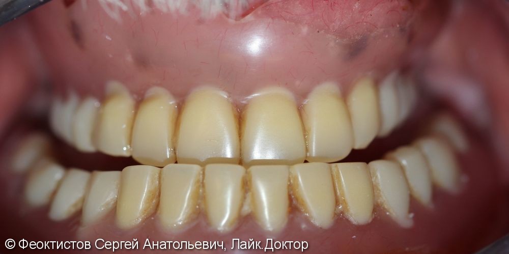 Повторное протезирование съемными протезами, гингивопластика - фото №2