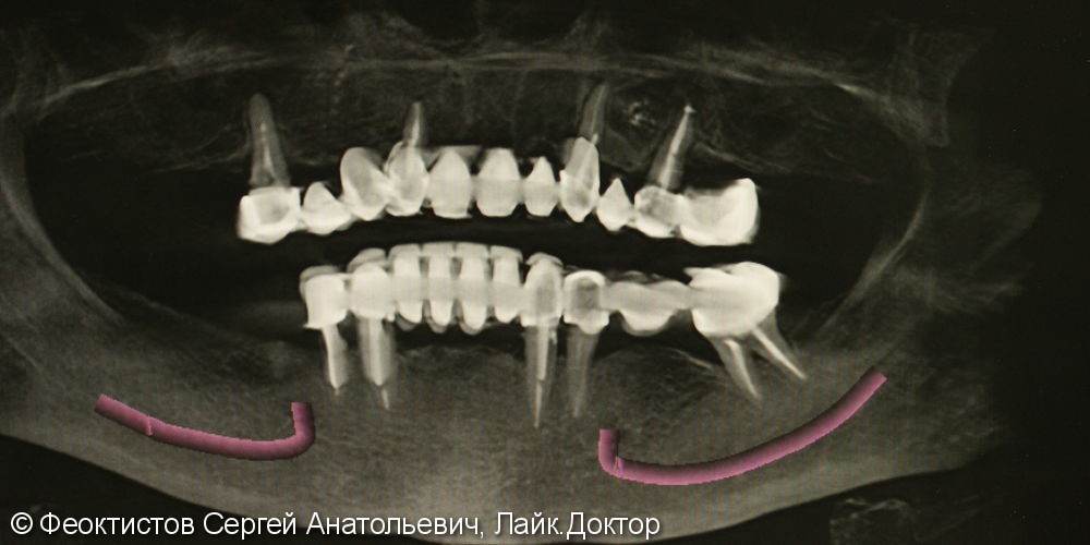 Условно-съемная конструкция на 5-ти имплантатах (All on 5) верхняя челюсть - фото №4