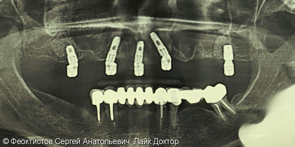 Условно-съемная конструкция на 5-ти имплантатах (All on 5) верхняя челюсть - фото №5