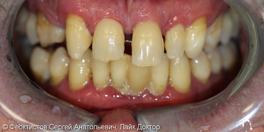 Протезирование зубов на имплантатах при полном их отсутствии (All on 4-6-8) - фото №1
