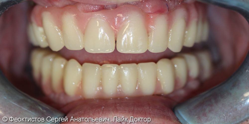Протезирование зубов на имплантатах при полном их отсутствии (All on 4-6-8) - фото №2
