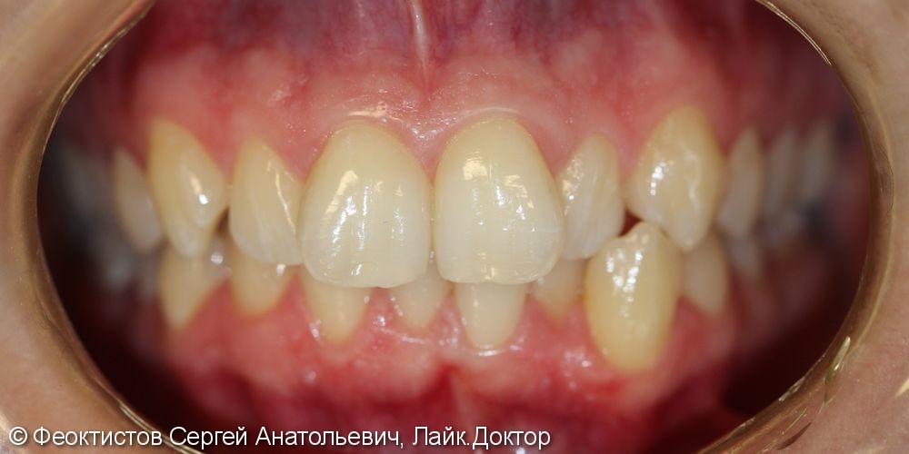 Ортодонтическон лечение брекетами Damon-Q - фото №1