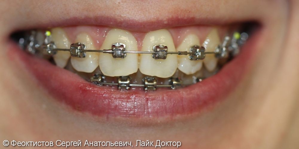 Ортодонтическон лечение брекетами Damon-Q - фото №10