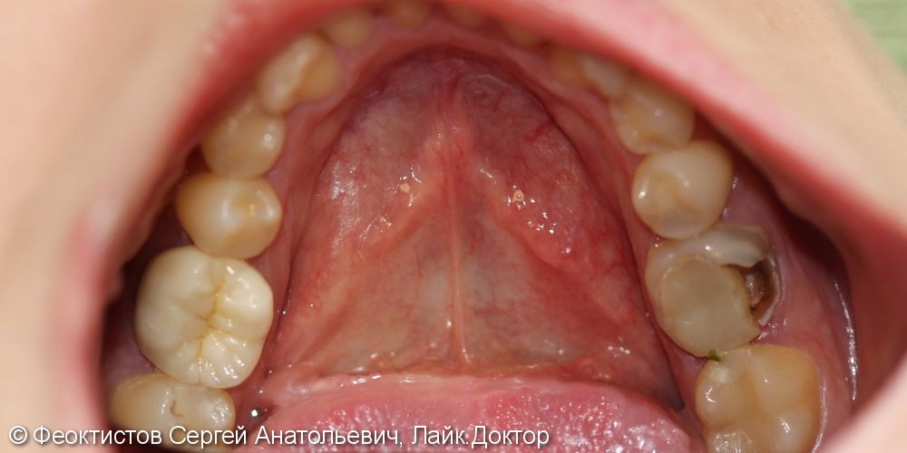 Удаление зуба 36 с последующей имплантацией и протезированием, до и после - фото №1
